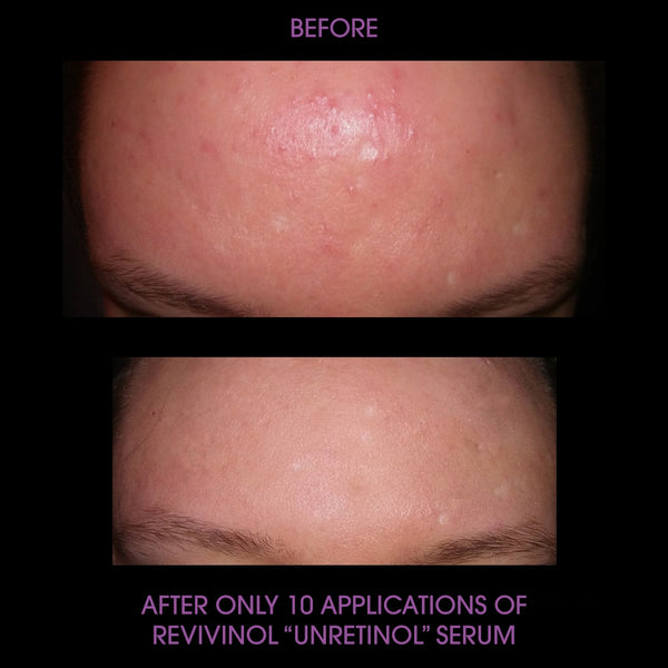Before After Revivinol with Bakuchiol