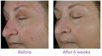 Before After photos Test of Sytenol A, a component of Revivinol Serum