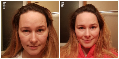 Before and after HA7X Multi-Molecular Serum, great results!