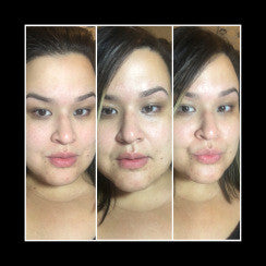Results of using HA7X Multi-Molecular Hydrator Serum with Neurophroline