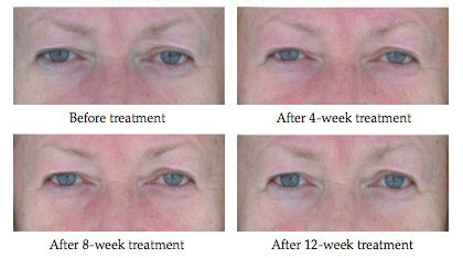 Before After photos Sytenol A Bakichiol in Revivinol Serum