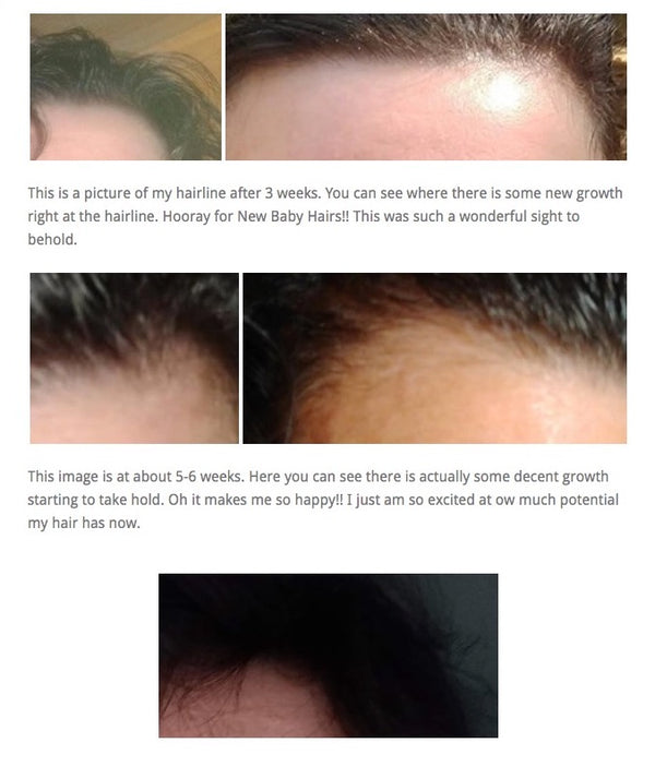 Before After photos for RevivHair REV