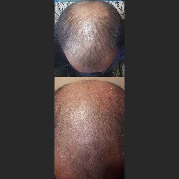 Before After RevivHair Max