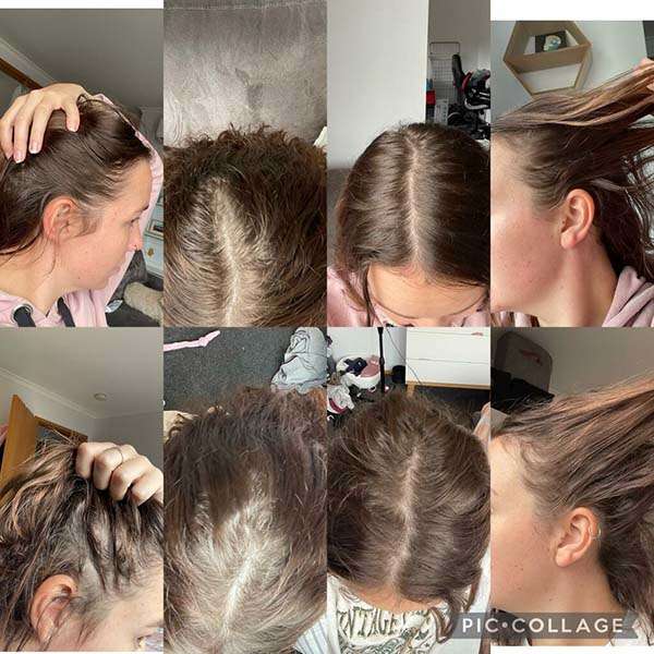 Before After RevivHair Max