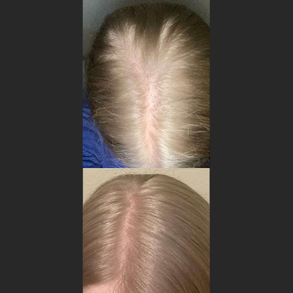 Before After RevivHair Max