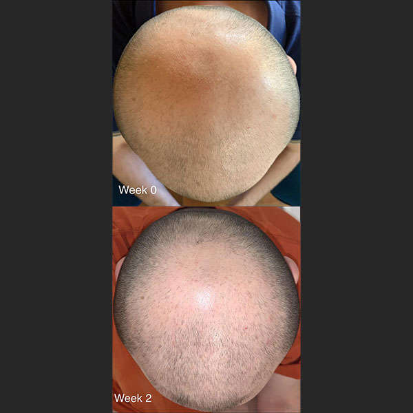 Before After RevivHair Max