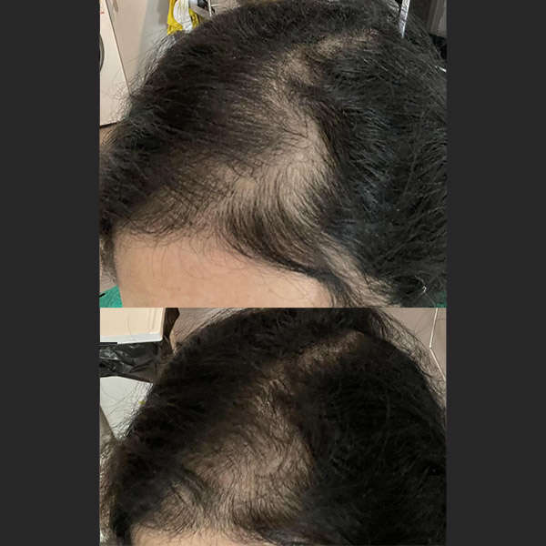 Before After RevivHair Max