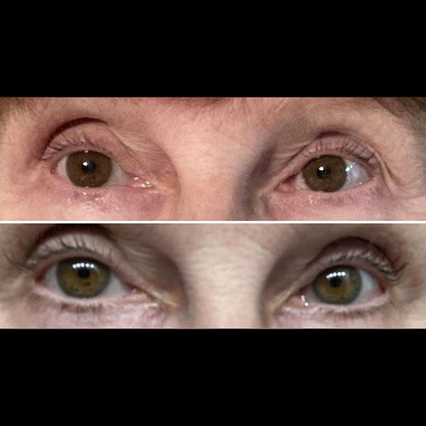 Before After RevivLash